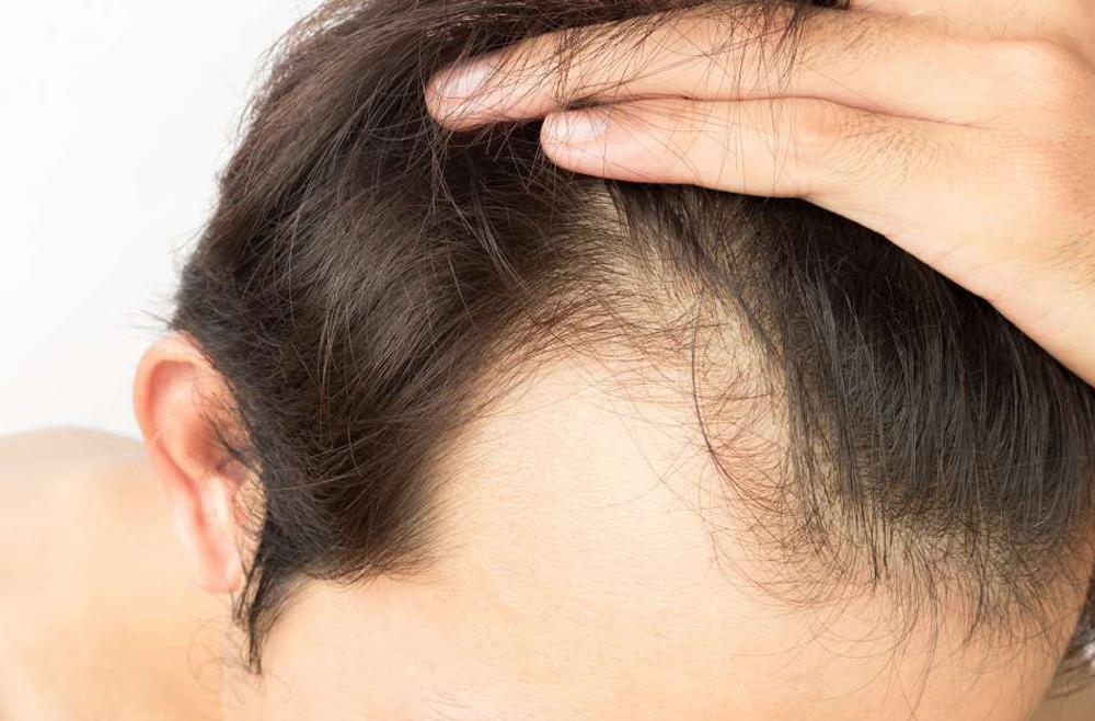 Answers to Your Hair Transplant Treatment Questions, By Dr. Shreyansh  Talesra - AMI