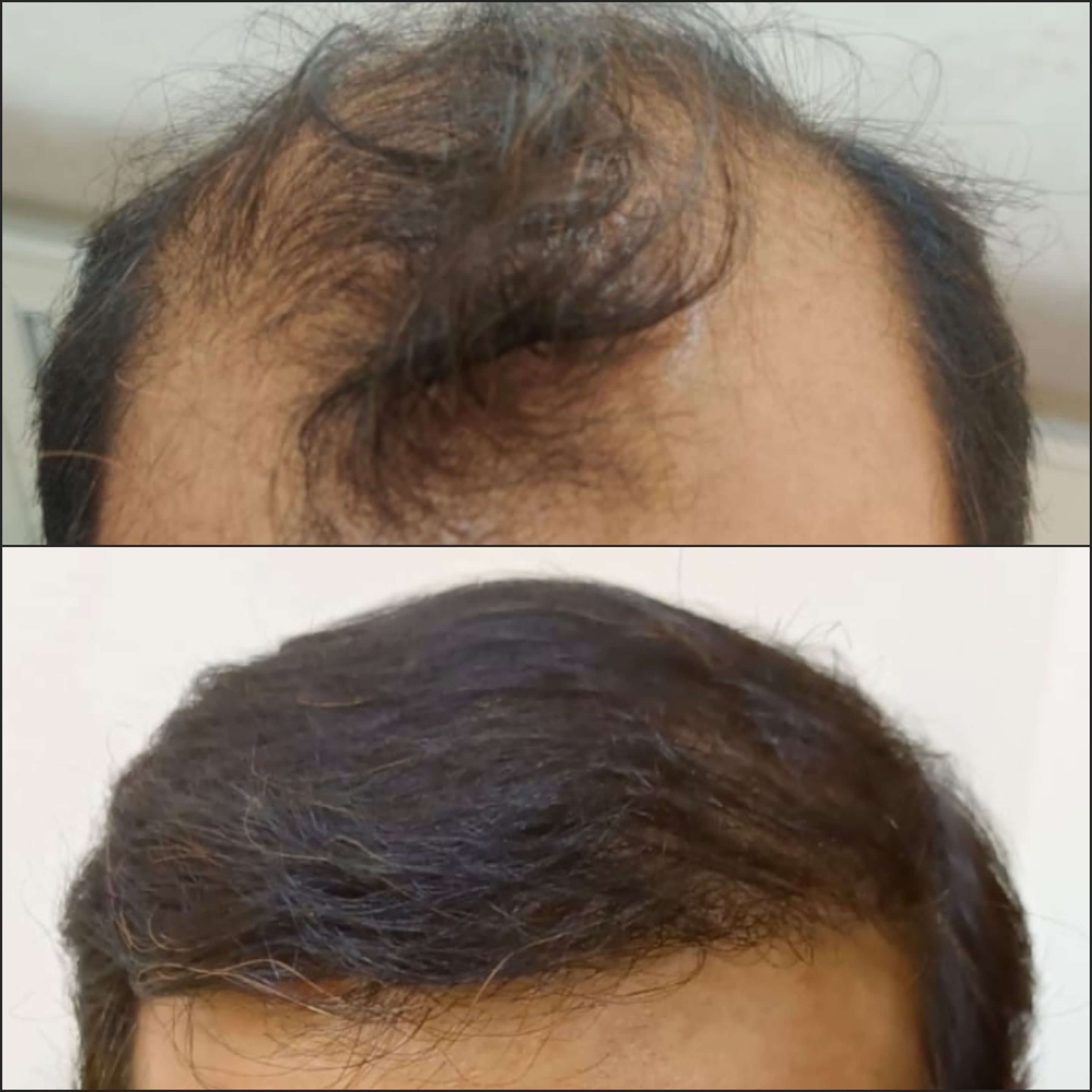 From Baldness to Beautiful Hair: How to Choose the Best Hair Transplant Surgeon